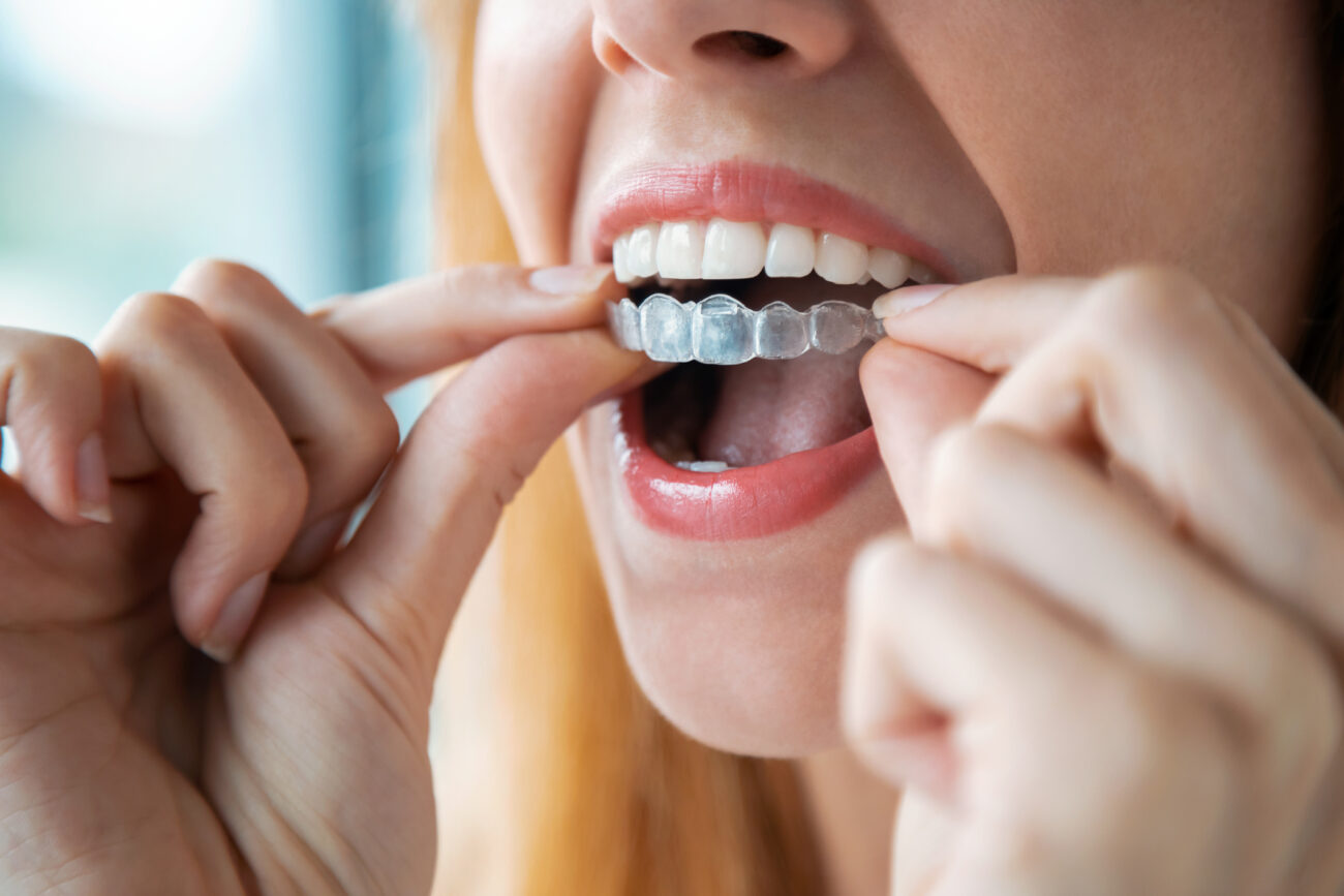 Considering Braces as An Adult? You Want to Think About Invisalign