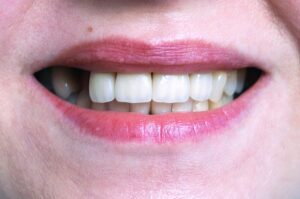 Does Tooth Loss Affect Cognition